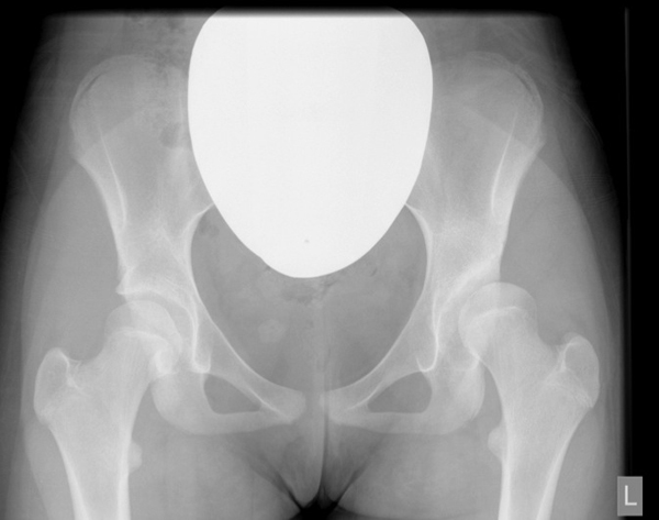 preoperative x ray showing shallow left hip socket.