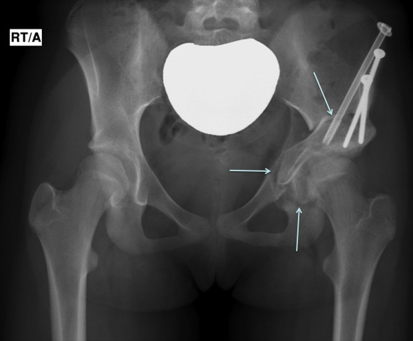 post operative x ray